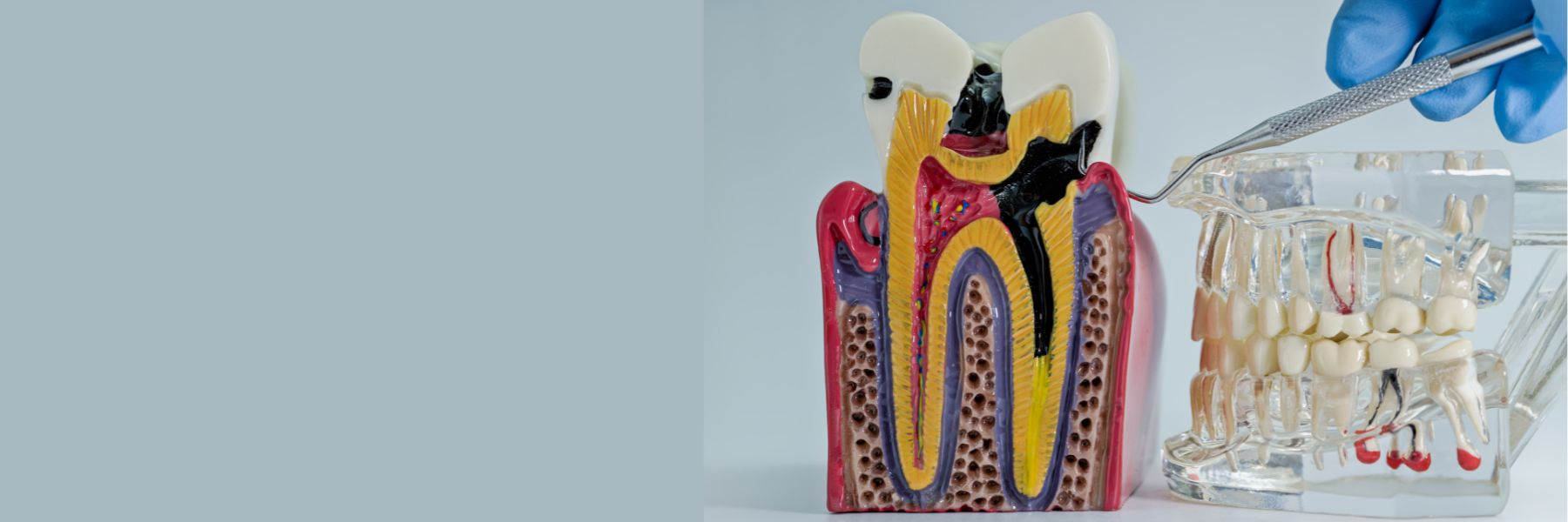 Root Canal Treatment | Dentist